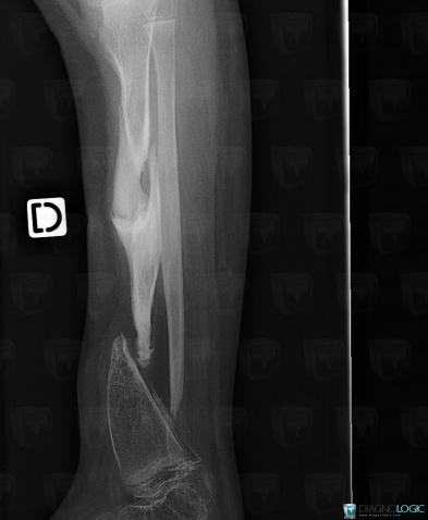 Congenital pseudarthrosis, Tibia - Mid part, X rays