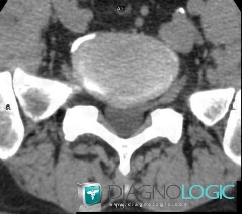 Conjoined nerve roots, Spinal canal / Cord, CT