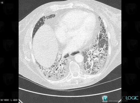 Connectivite mixte, Parenchyme pulmonaire, Scanner