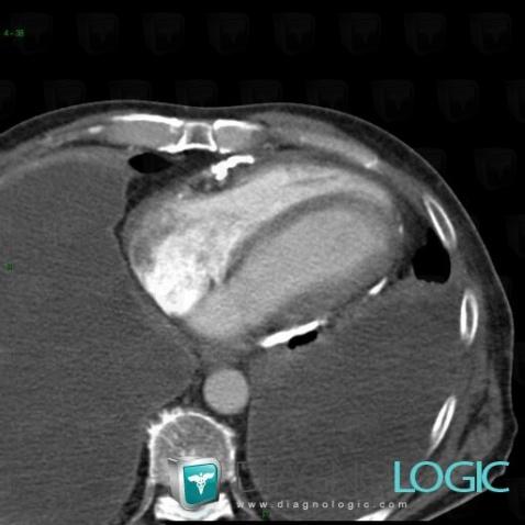 Constrictive pericarditis, Cardiac cavities / Pericardium, CT