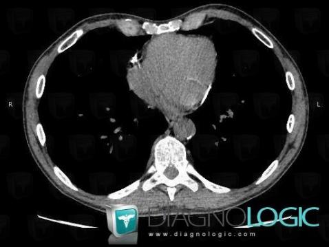 Constrictive pericarditis, Cardiac cavities / Pericardium, CT