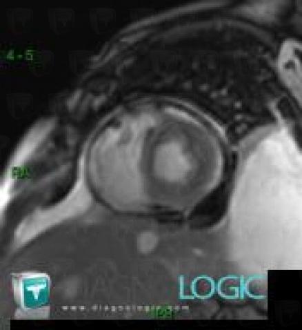 Constrictive pericarditis, Cardiac cavities / Pericardium, MRI