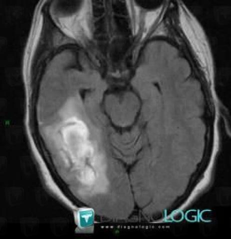 Contusion, Cerebral hemispheres, MRI