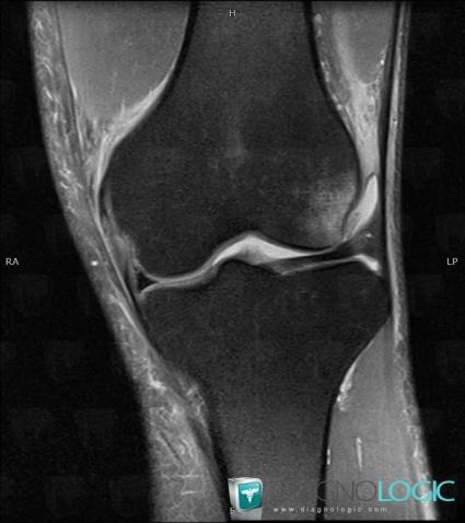 Contusion, Femur - Distal part, MRI