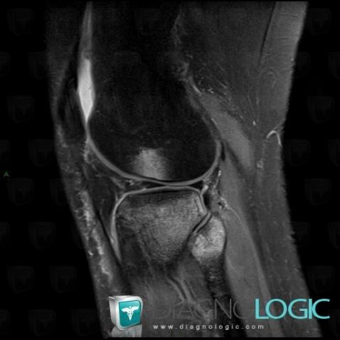 Contusion, Femur - Distal part, Tibia - Proximal part, MRI