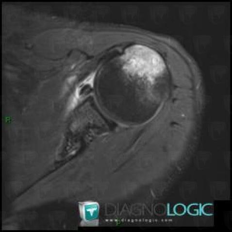 Contusion, Humerus - Proximal part, MRI