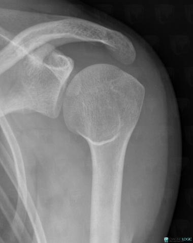 Contusion, Humerus - Proximal part, X rays