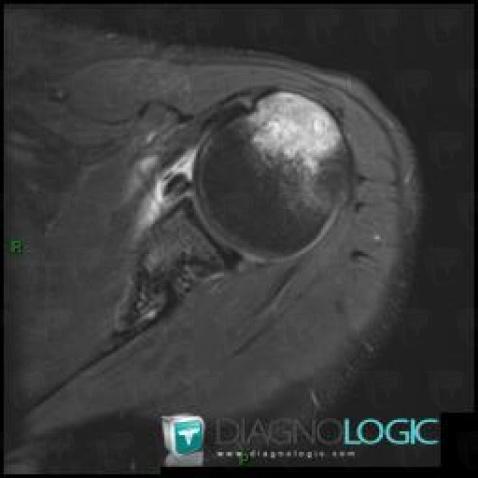 Contusion, Humérus -supérieur, IRM