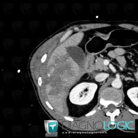 Contusion, Liver, CT