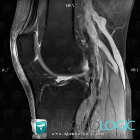 Contusion, Other soft tissues/nerves - Knee, MRI