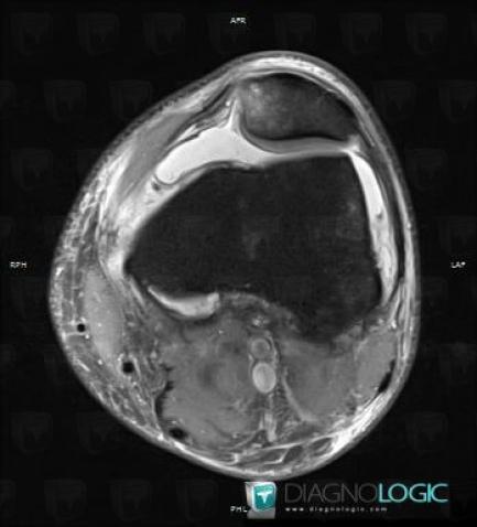 Contusion, Patella, MRI