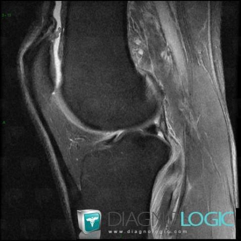 Contusion, Popliteus tendon, MRI