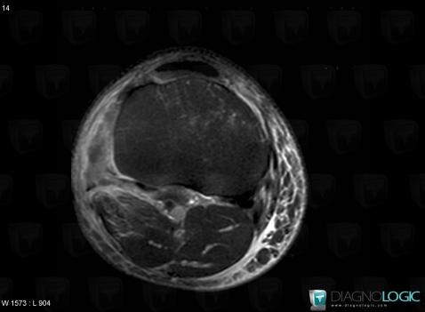 Contusion, Popliteus tendon, MRI