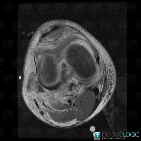 Contusion, Popliteus tendon, MRI