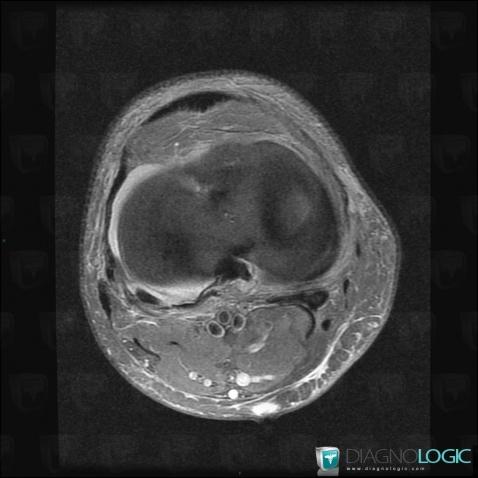 Contusion, Popliteus tendon, MRI