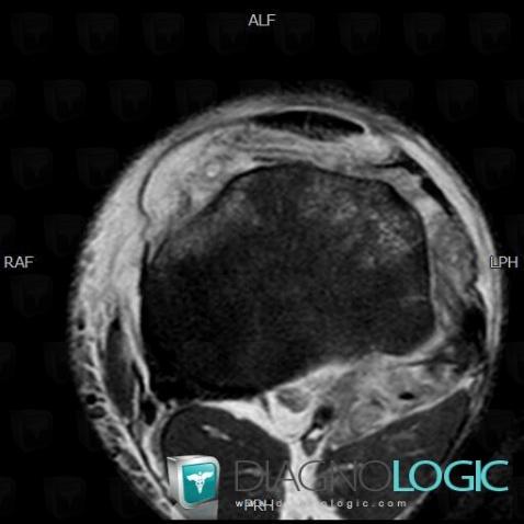 Contusion, Popliteus tendon, MRI