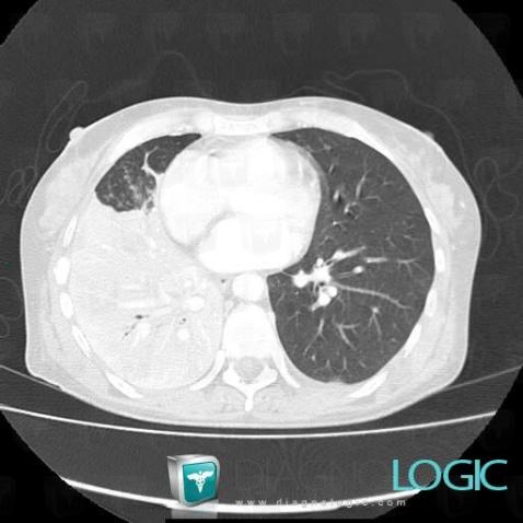 Contusion pulmonaire, Parenchyme pulmonaire, Scanner