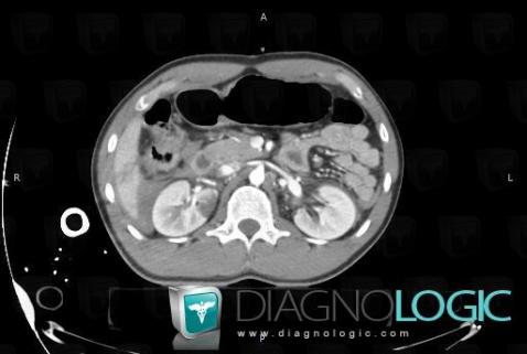Contusion, Rein, Scanner