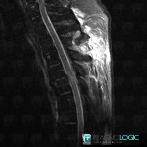 Contusion, Spinal canal / Cord, MRI