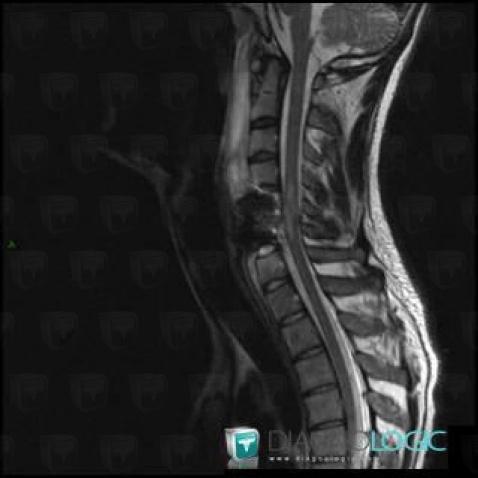 Contusion, Spinal canal / Cord, MRI