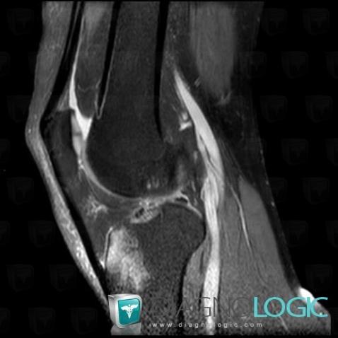 Contusion, Tibia -supérieur, IRM
