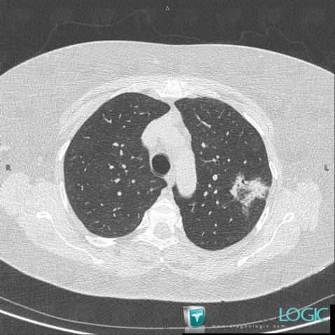 COP, Pulmonary parenchyma, CT