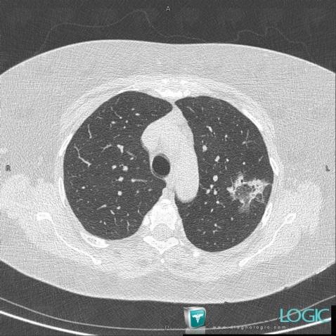 COP, Pulmonary parenchyma, CT