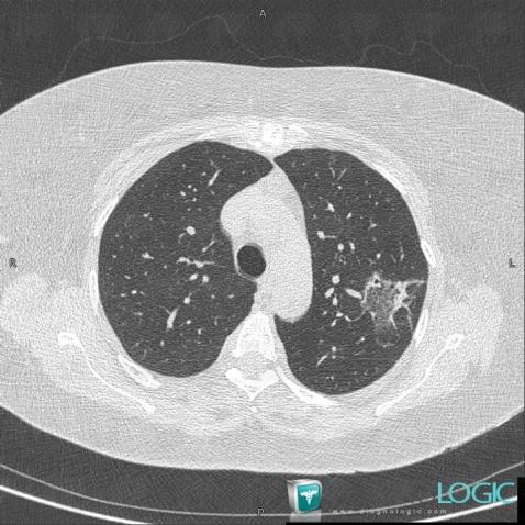 COP, Pulmonary parenchyma, CT