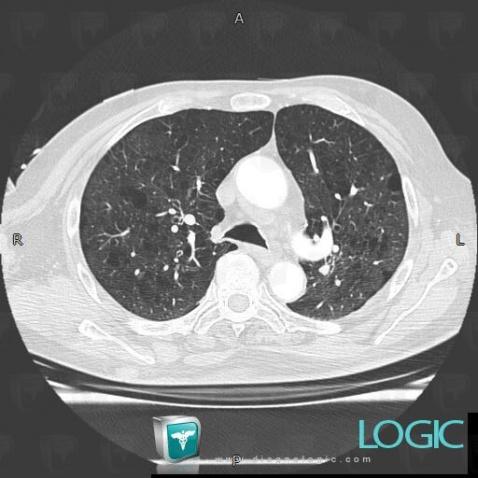 COPD, Pulmonary parenchyma, CT