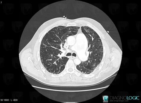 COPD, Pulmonary parenchyma, CT