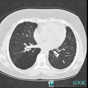 COPD, Pulmonary parenchyma, CT