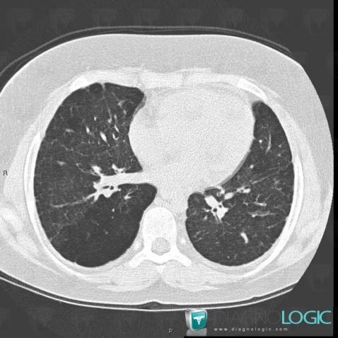 COPD, Pulmonary parenchyma, CT