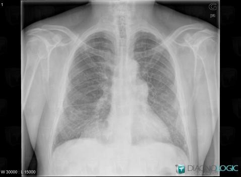 COPD, Pulmonary parenchyma, X rays