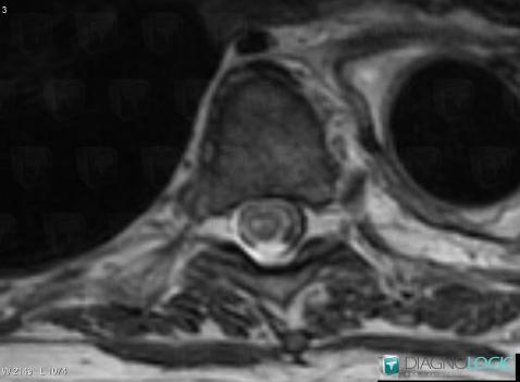 Cord infarction, Spinal canal / Cord, MRI