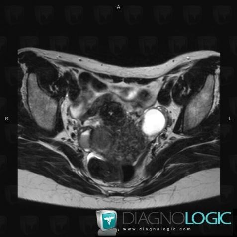 Corpus luteum, Adnexa / Ovary fallopian tube, Pelvis / Perineum, MRI