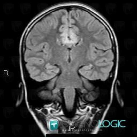Cortical dysplasia, Cortico subcortical region, Cerebral hemispheres, MRI