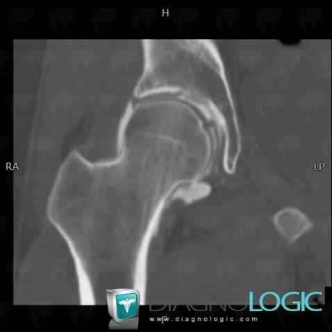 Coxa valga, Femur - Proximal part, CT