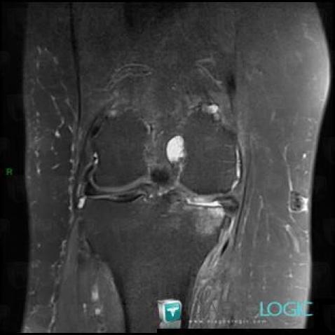 CPPD, Femorotibial joints - Intercondylar notch, MRI