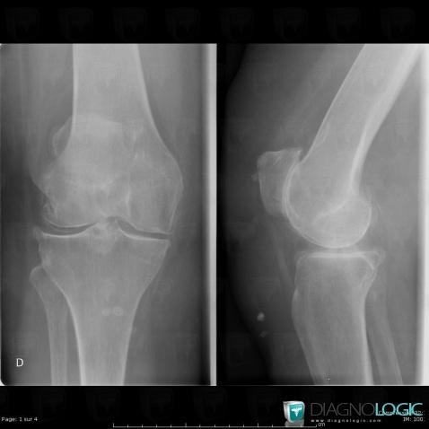 CPPD, Femorotibial joints - Intercondylar notch, X rays