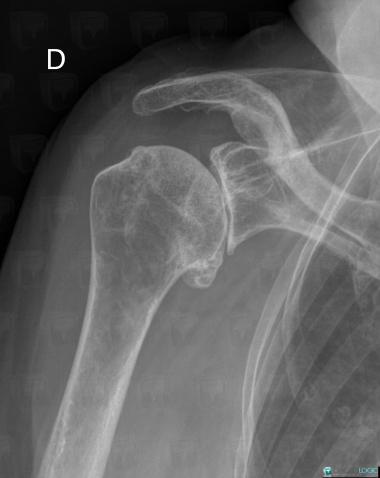 Radiology case : Degenerative joint disease (X rays) - Diagnologic