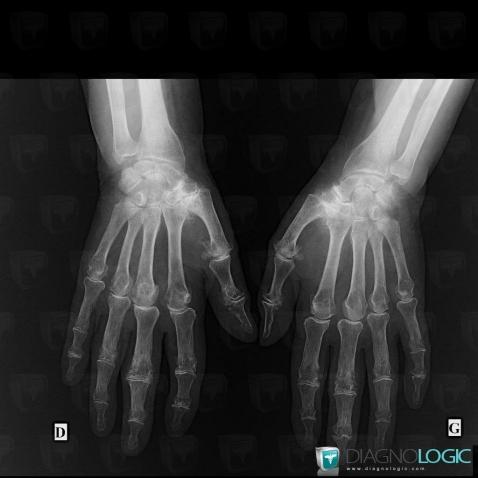 CPPD, Mediocarpal joint, Carpometacarpal joint, X rays