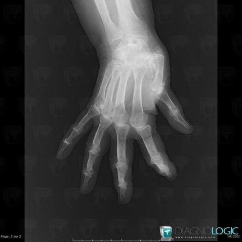 CPPD, Mediocarpal joint, Metacarpophalangeal joints, X rays