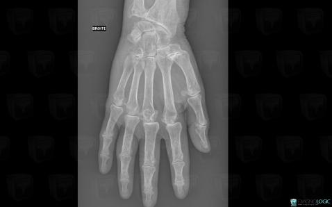 CPPD, Metacarpophalangeal joints, X rays