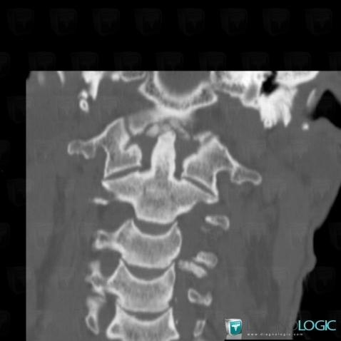 CPPD, Vertebral body / Disk, CT