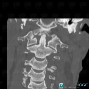 CPPD, Vertebral body / Disk, CT