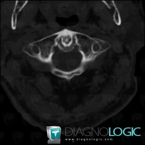 CPPD, Vertebral body / Disk, CT