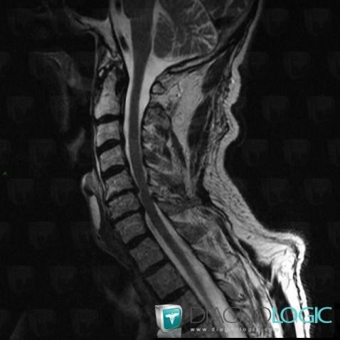 CPPD, Vertebral body / Disk, MRI