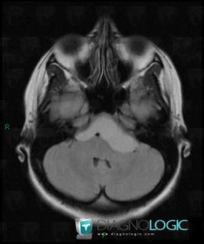 Craniopharyngioma, Cerebellopontine angle, MRI