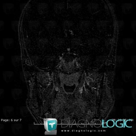 Craniopharyngioma, Cerebral hemispheres, MRI