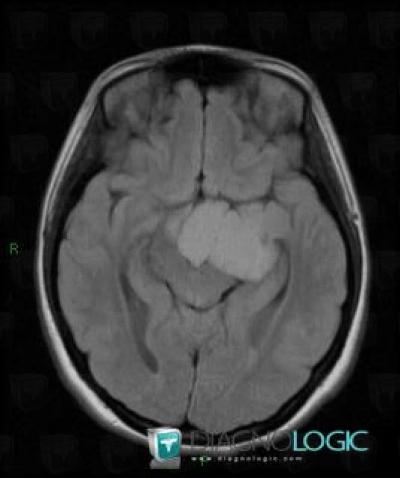 Craniopharyngioma, Cerebral hemispheres, MRI